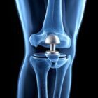 Medical device in knee